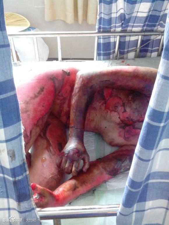 山东16岁女孩烧伤图片